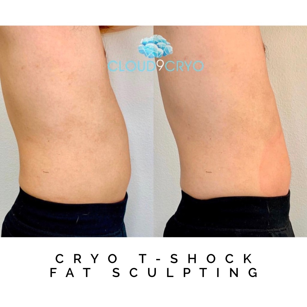 Cloud9Cryo All Treatments Cryo TShock Studio in Long Beach, CA